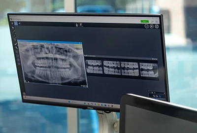Digital dental X-rays on monitor in dentist office, showing panoramic and bitewing radiographs.